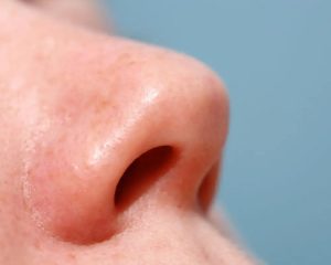درمان لک های روی بینی با زعفران